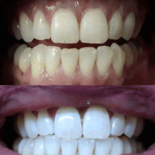 Load image into Gallery viewer, Teeth Whitening
